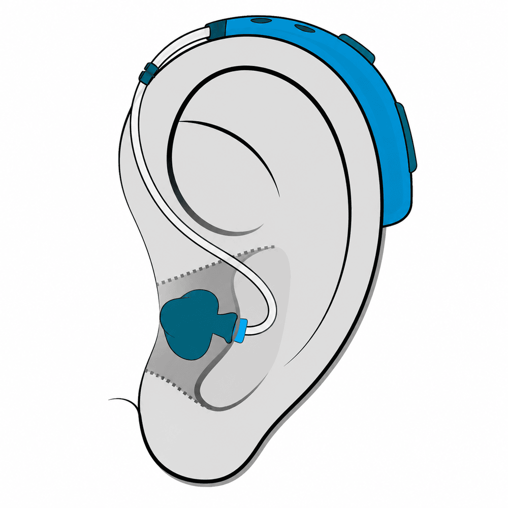 Behind-the-ear (BTE) hearing aid style fitted at AUDIO-LOGIC, PC in Columbus, NE