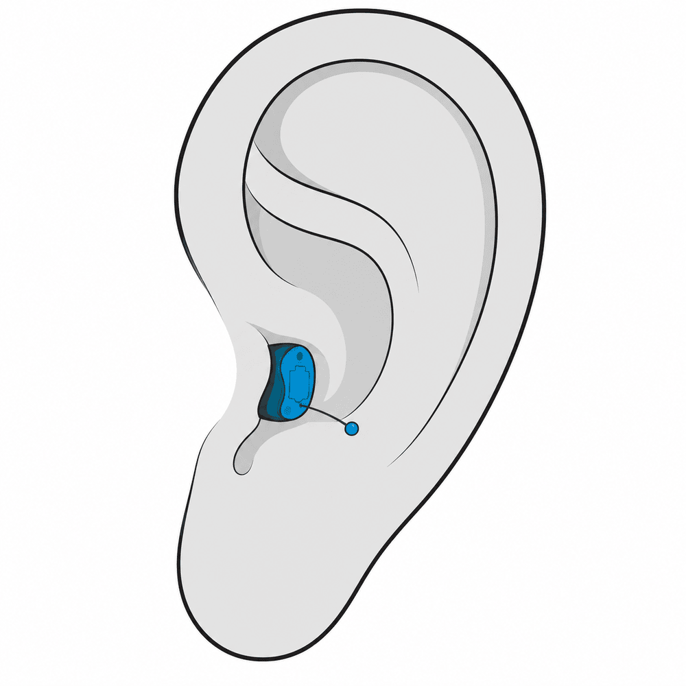Completely-in-canal (CIC) custom hearing aid style fitted at AUDIO-LOGIC, PC in Columbus, NE